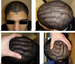 pachydermy-specialist-scalp